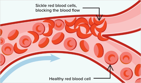 Sickle cell infographic